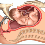 elective-caesarean-section-d413af Best Gynecologist in Jaipur