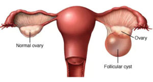 sty Best Gynecologist in Jaipur